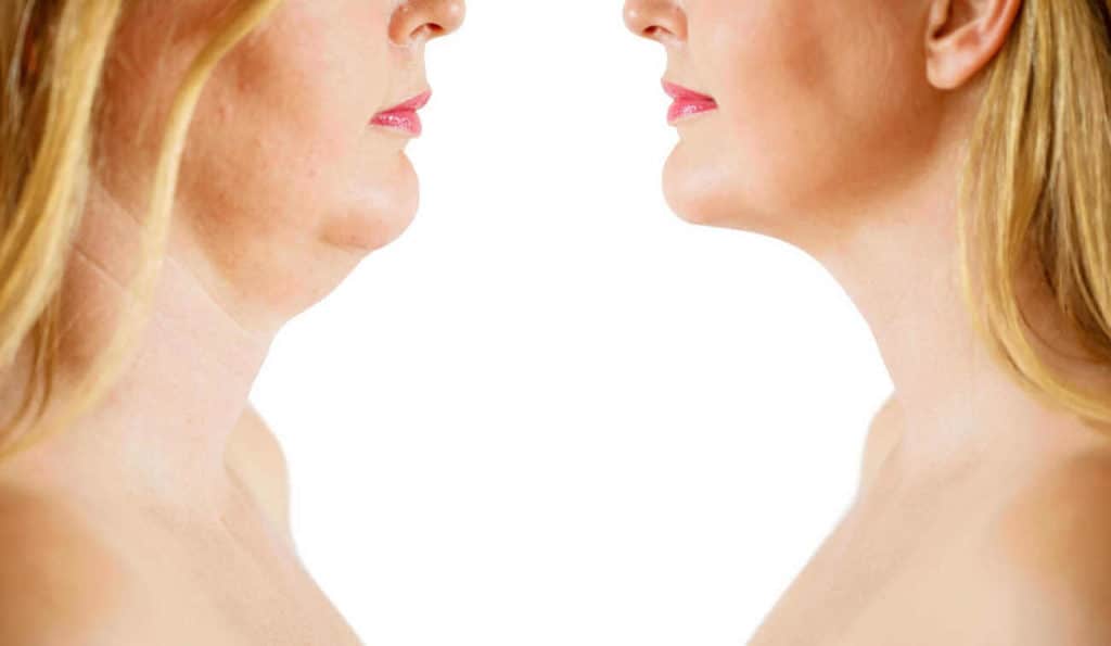 Double Chin treatment Hampstead Garden Suburb before and after results