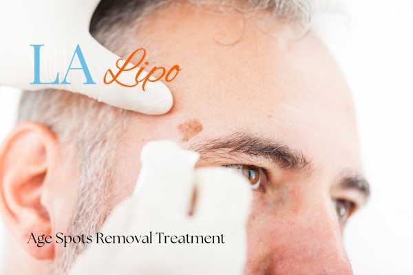 What Are the Most Effective Treatments for Age Spots Hampstead Garden Suburb?