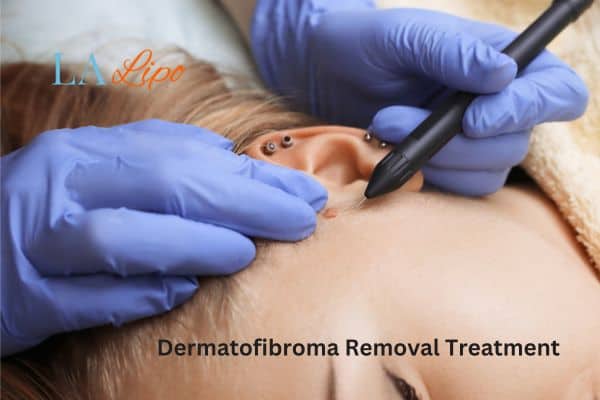 Dermatofibroma Removal Treatment Hampstead Garden Suburb
