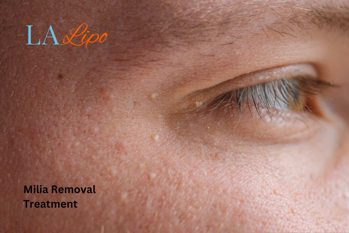 Cryopen Milia Removal: Is It the Easiest and Safest Option Hampstead Garden Suburb?