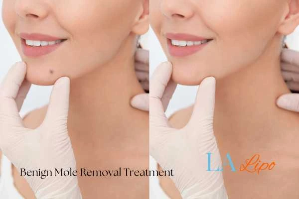 woman's before and after mole removal Hampstead Garden Suburb results