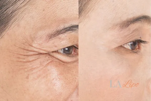 Before and after results of woman - HI-fu wrinkles reduction treatment Hampstead Garden Suburb