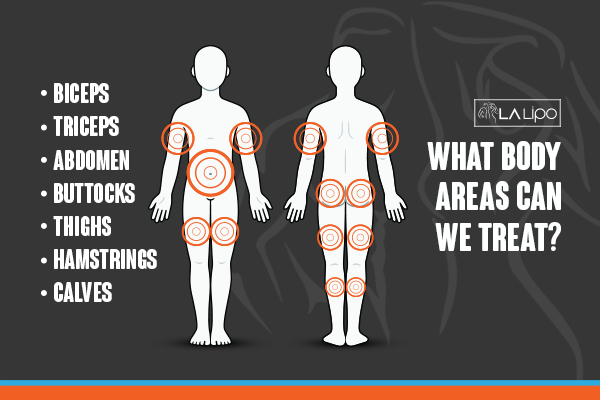 Graphic to show areas you can have LA-EMS Body Sculpting Hampstead Garden Suburb treatment.