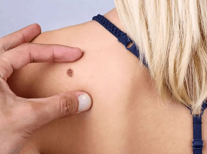 woman having mole removal Hampstead Garden Suburb consultation before treatment.