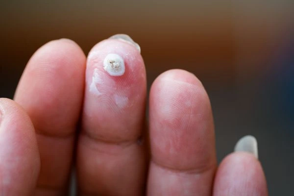 wart on person finger - cryotherapy to treat from LA LIPO Hampstead Garden Suburb