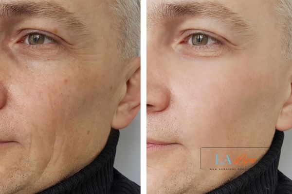 See the amazing results of Morpheus8 Treatment Hampstead Garden Suburb!