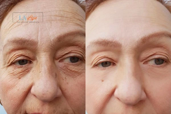 The powerful benefits of Morpheus8 Treatment Hampstead Garden Suburb - Call Our team today!