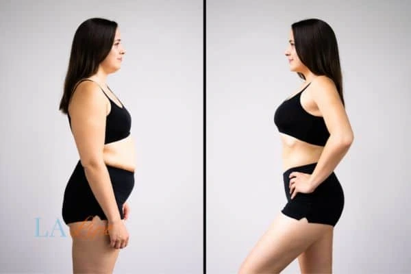 Picture of womans before and after using LA-EMS body sculpting to improve her core strength Hampstead Garden Suburb