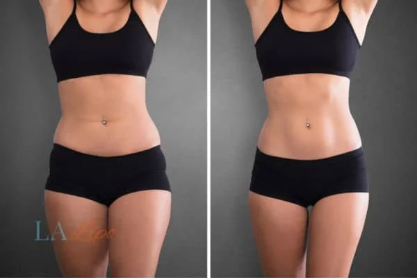 before and after results of non-surgical treatment to help a woman's body image and mental health Hampstead Garden Suburb