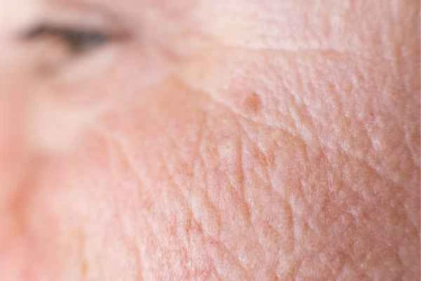 close up picture of a woman's face showing an age spot Hampstead Garden Suburb