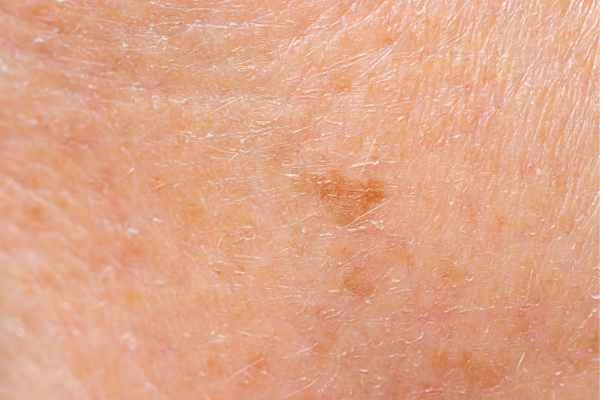close up picture of age spots Hampstead Garden Suburb