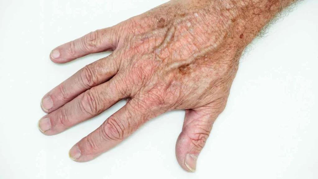 Male hand showing age spot Hampstead Garden Suburb