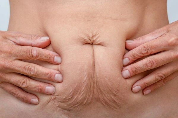 Image of a woman's stomach with loose skin - example of skin tightening Hampstead Garden Suburb options