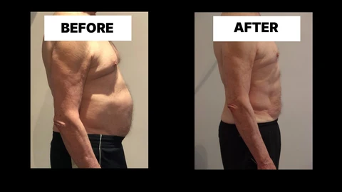 What Symptoms Can Diastasis Recti Cause in Men? Weak Core, Back Pain and Poor Posture Hampstead Garden Suburb