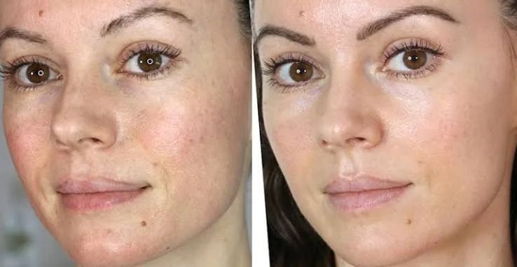 What happens during treatment Hampstead Garden Suburb